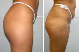 cellulite-12_lbb